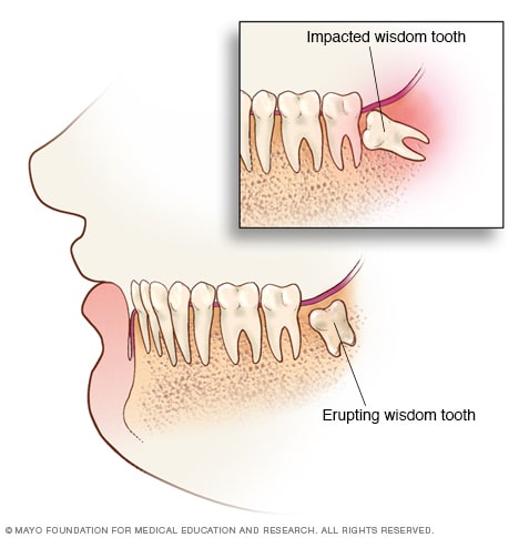 # The Role of Wisdom Teeth in Your Mouth