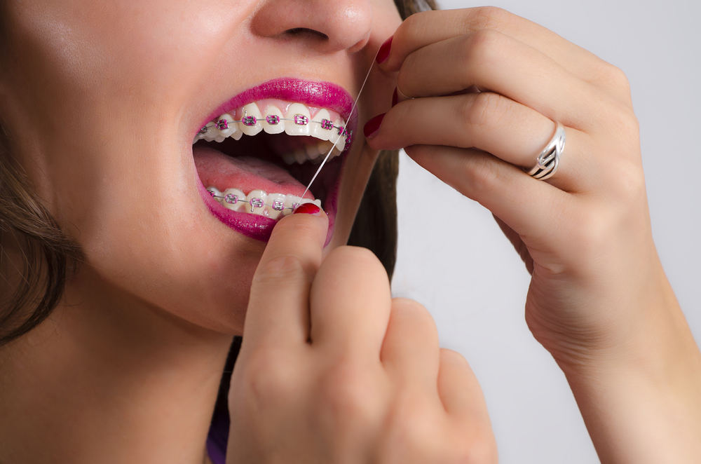 # Do You Need to Floss with Braces?
